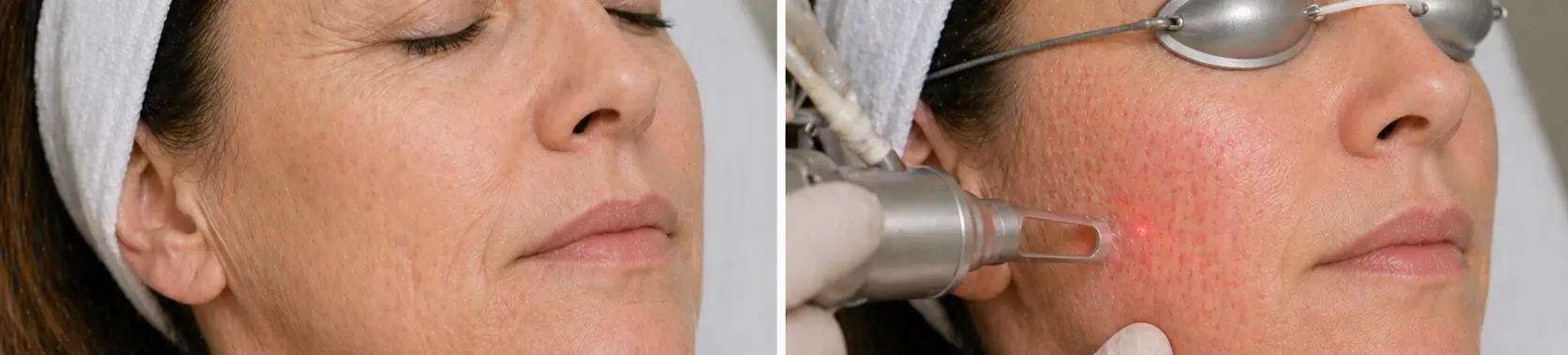 Paciente luego de tratamiento de láser facial