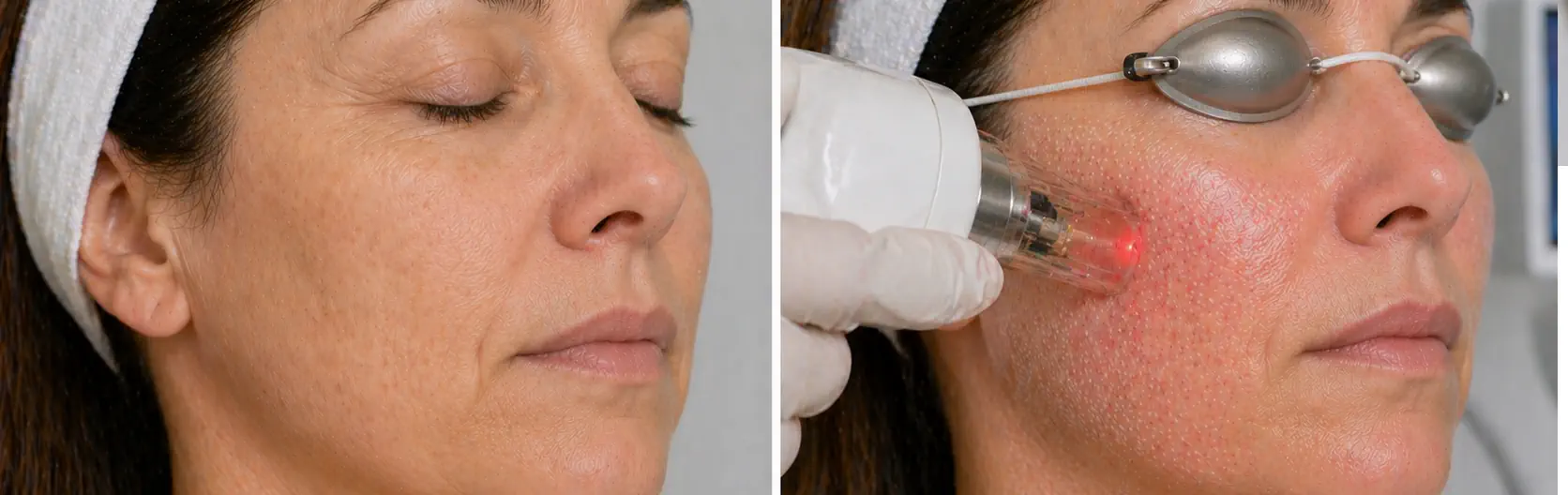 Tratamiento láser para textura de piel