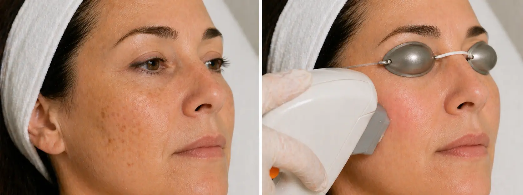 Tratamiento de luz pulsada para manchas solares