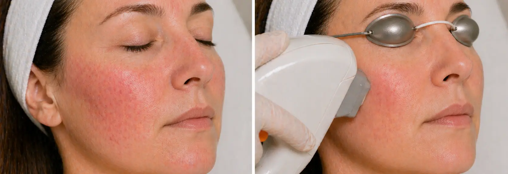 Tratamiento de luz pulsada para rosácea